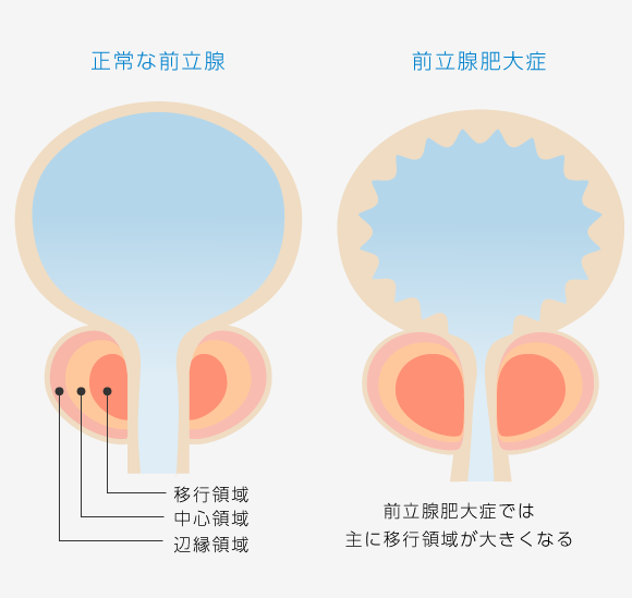 前立腺肥大症と正常な前立腺の比較イメージイラスト